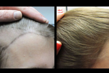 Hair Loss Treatment