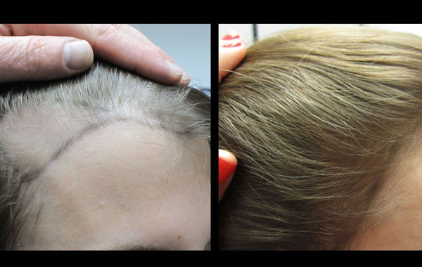 Hair Loss Treatment